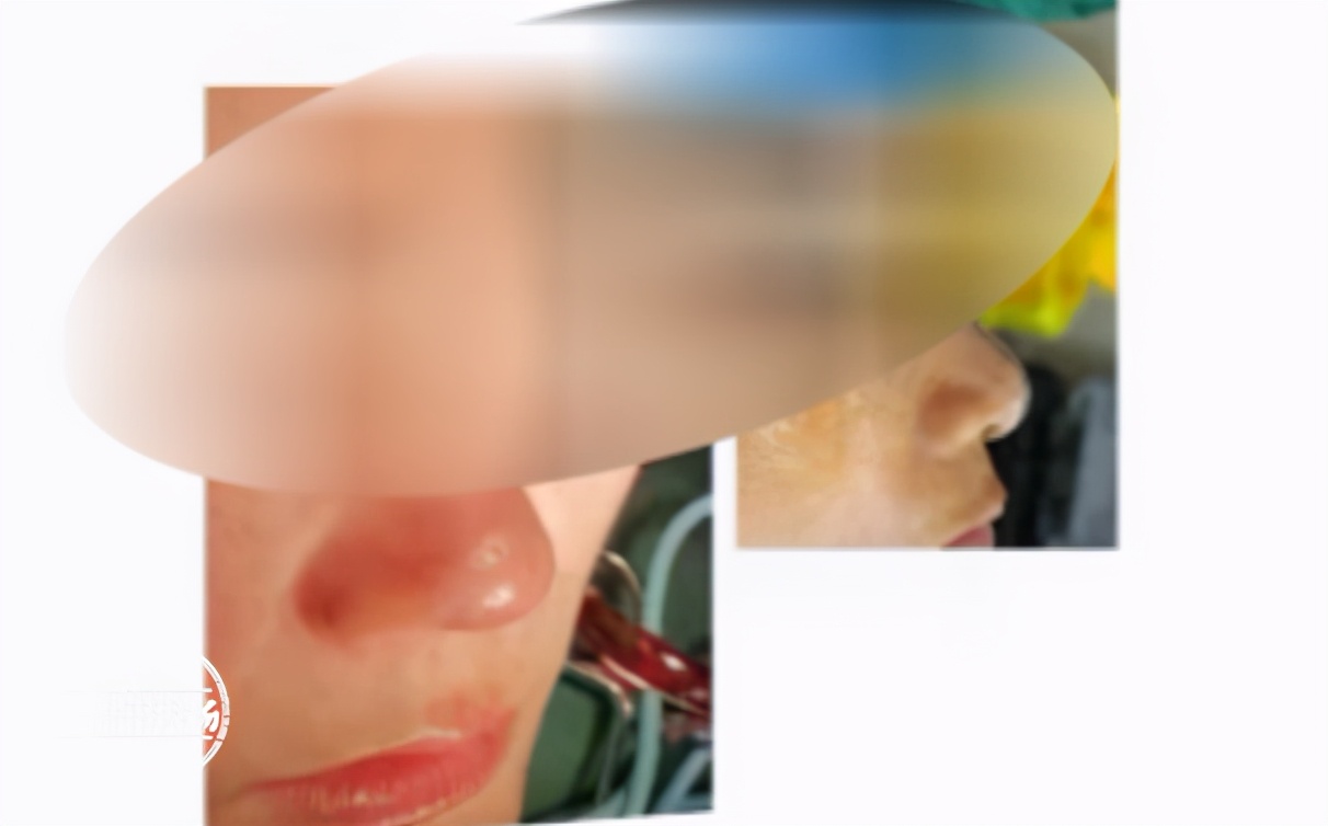 女子隆鼻后紅腫不透氣 江西省皮膚病?？漆t院被投訴